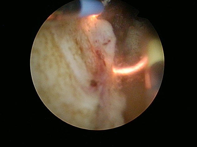 実際の切除中のループ