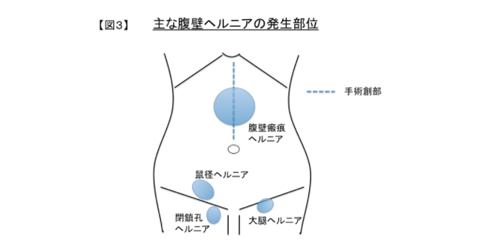 どのようなタイプがあるの？