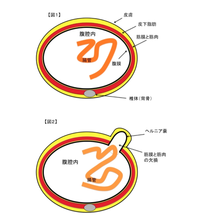 腹壁ヘルニアとは？